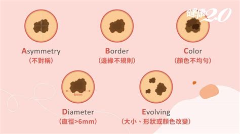 虎口突然長痣|別把癌當痣！5部位冒黑點恐是惡性黑色素瘤 台大醫師。